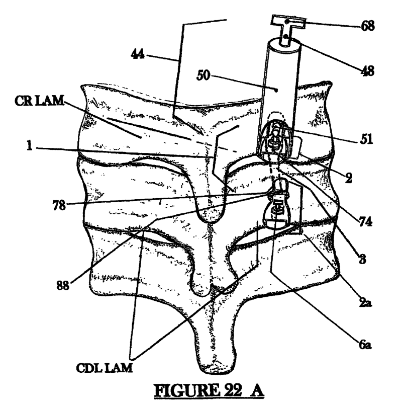 Image taken from the Cervi-Lok patent filing