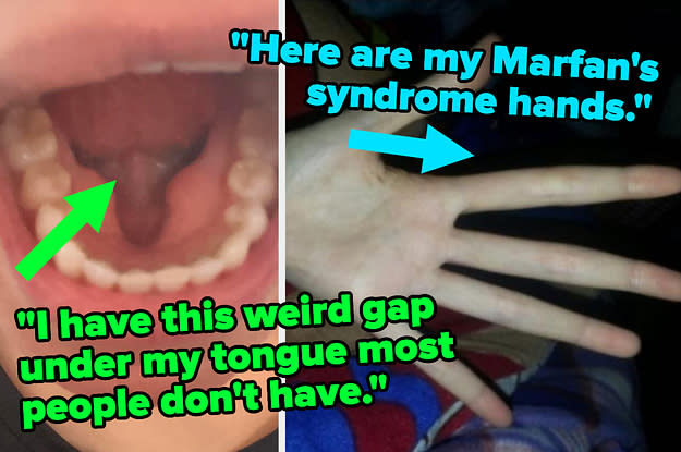 Marfan's Syndrome, Mandibular Tori, And 17 More Really Interesting Body  Abnormalities People Are Proudly Sharing
