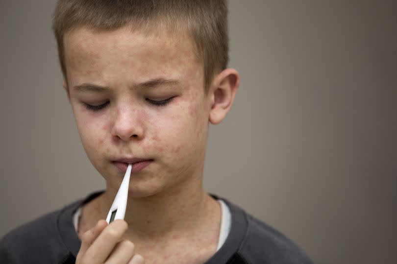 Child with measles