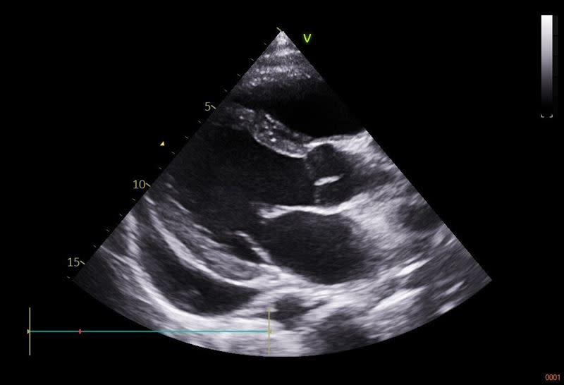 心肌炎病患心臟收縮力下降，超音波檢查呈現心室擴大，同時合併心包膜發炎，所以也發現大量的心臟外積水，使得心臟舒張功能也受到影響。（圖／翻攝自花蓮慈濟醫院）