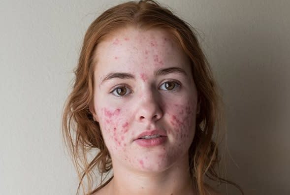 This girl’s before-and-after acne selfies are going viral for an important reason