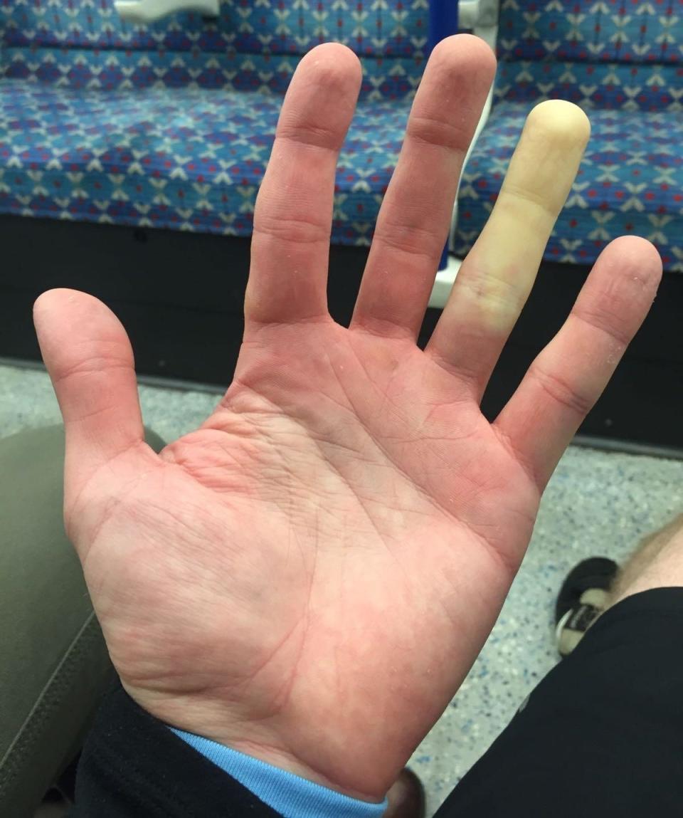 A finger with Raynaud's Phenomenon