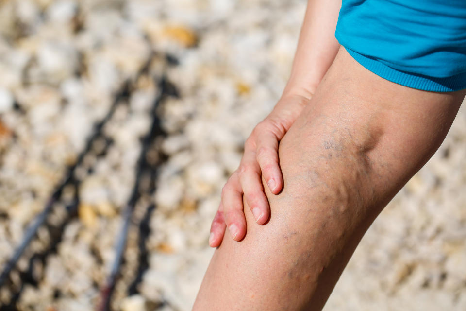 El dolor en las piernas es común y, en la mayoría de los casos, suele ser inofensivo. Pero para algunas personas podría ser una señal de un cáncer común con el que no lo asociamos. (Foto: Getty).