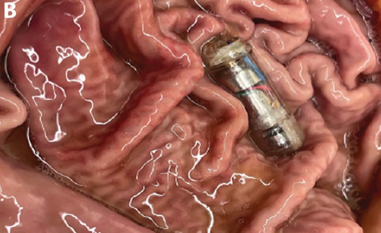 Una píldora electrónica que vibra y ofrece una sensación de saciedad | Srinivasan, Shriya S., et al. Science Advances (2023)