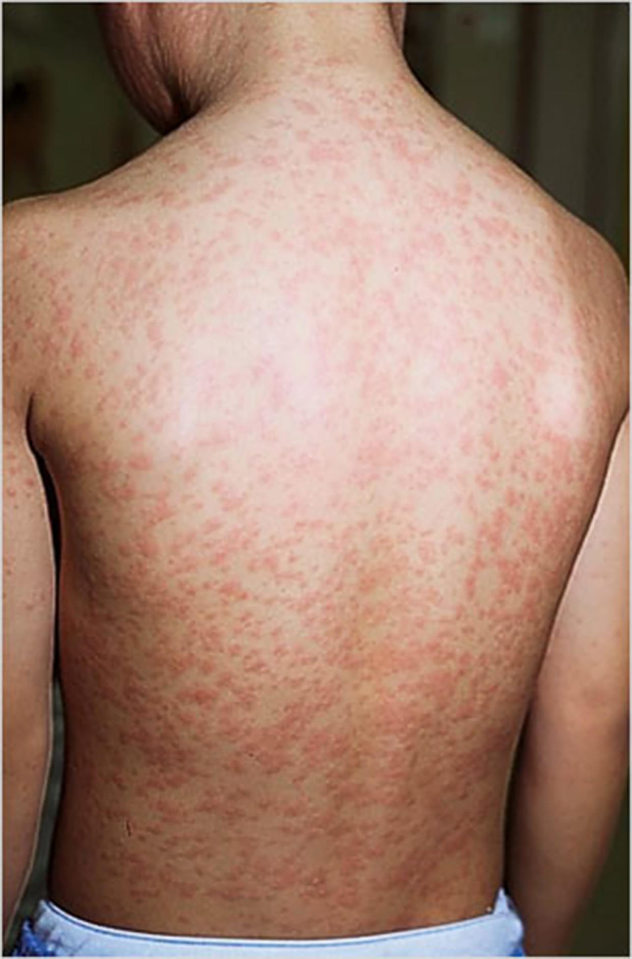 A measles rash. (Courtesy Centers for Disease Control and Prevention )