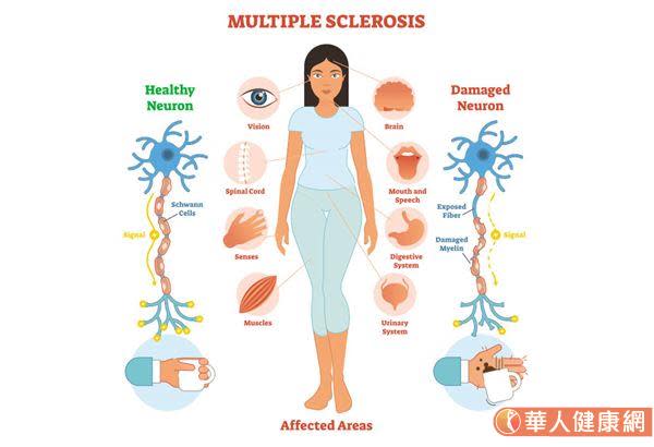 多發性硬化症目前尚無明確預防發病方法，呼籲大眾倘若忽然出現麻痺、肢體無力、步態不穩、暈眩、視力受損、大小便機能失調等症狀，建議可至神經科就診，做出進一步疾病診斷。