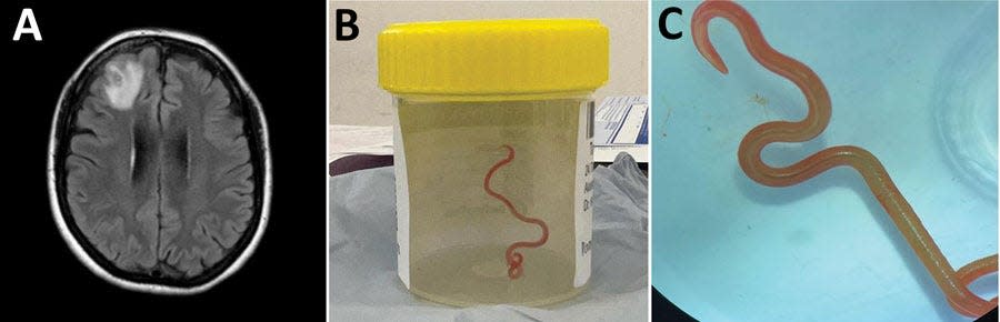 Photos of the patient's brain scan and the extracted roundworm.