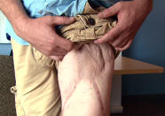 In this July 9, 2012 image made from video, Marine Sgt. Ron Strang shows his injured leg at the University of Pittsburgh Medical Center in Pittsburgh, Pa. He lost half of his thigh muscle from shrapnel in a bomb blast in Afghanistan, and with an experimental implant of connective tissue developed from pigs, it has had it strengthened. "It's been a huge improvement," he says. (AP Photo/Tom Sampson)