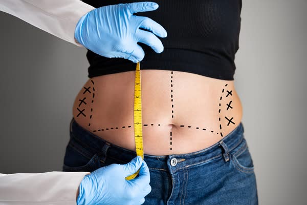 Slimming Down with an Abdominoplasty and Tummy Tuck