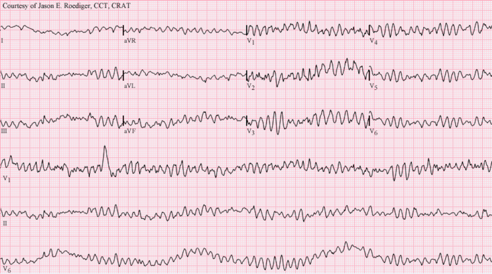 This ECG diagram shows the electrical signals of a heart in ventricular fibrillation. Compared to the ordered, repeating electrical pulses of a normal heartbeat, this ECG is much more chaotic. <a href="https://commons.wikimedia.org/wiki/File:Ventricular_fibrillation.png" rel="nofollow noopener" target="_blank" data-ylk="slk:Jer5150/Wikimedia Commons;elm:context_link;itc:0;sec:content-canvas" class="link ">Jer5150/Wikimedia Commons</a>, <a href="http://creativecommons.org/licenses/by-sa/4.0/" rel="nofollow noopener" target="_blank" data-ylk="slk:CC BY-SA;elm:context_link;itc:0;sec:content-canvas" class="link ">CC BY-SA</a>