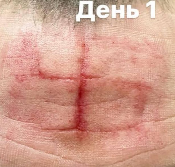 Two soldiers are being treated for swastika-shaped torture scars