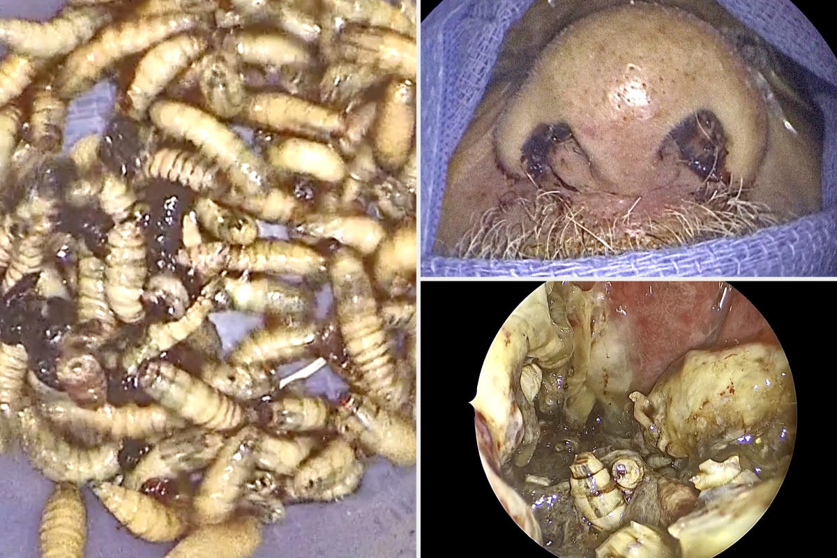 Florida man has 150 live bugs removed from his nose — and he didn