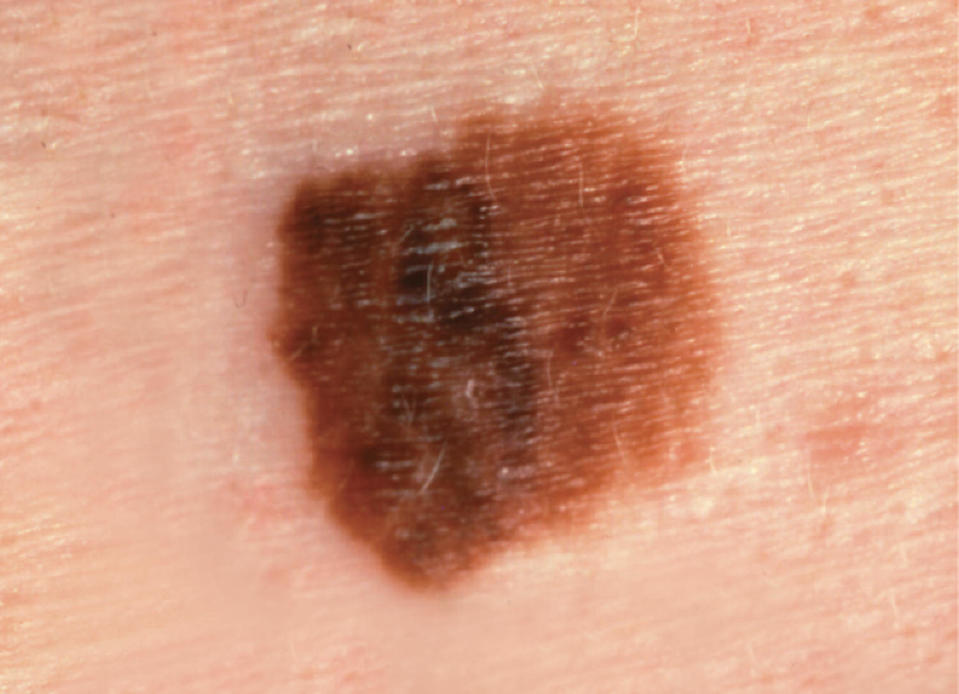 A picture of a melanoma with a diameter of greater than one-quarter inch. (Courtesy The Skin Cancer Foundation)