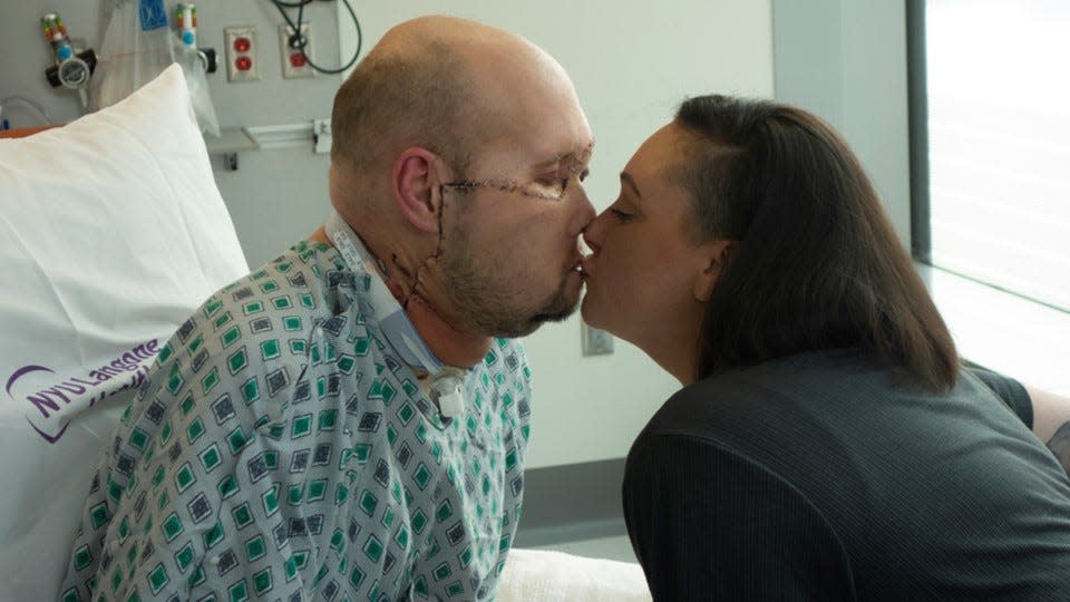 Aaron and Meagan James kiss for the first time since Aaron received a face and eye transplant following a 2021 injury.