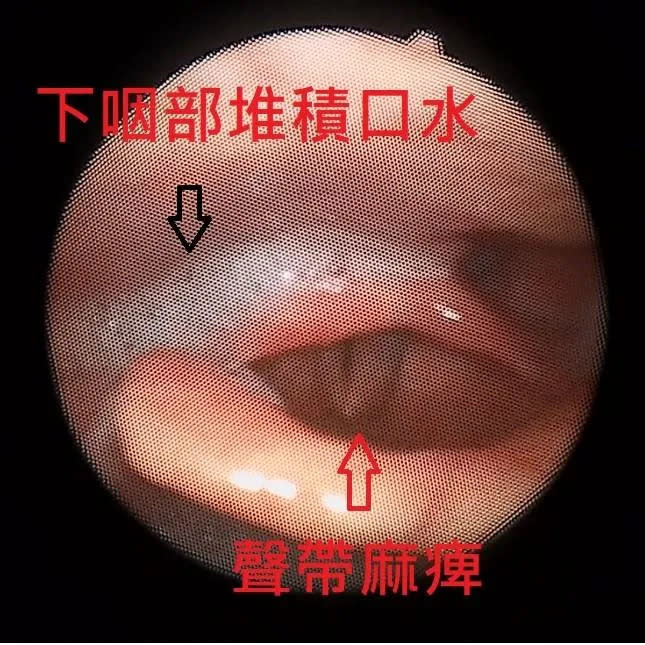 <strong>阿博卡痰一年多就醫檢查驚見「聲帶已經幾乎不太會動」。（圖／【</strong><a href="https://www.facebook.com/ent33chen?__cft__[0]=AZWfVzcJ-i0D4v-bhgrDbsKXM3VW9nx6_7SXt5XRngd1pKCkpy1VWQsAymBhdojpjyVNCzupn_qEKI-E3xNhp0NaUBC6h9yTwpO45Selb6MiwBozssUcltgtU028rYOlcZsjOP8oHluKwD2rGk8gyjQhXzSC8VhYSeGe95_jG5ZRPt45OPdpLU5cyh8lVc6Y8Lw&__tn__=-UC*F" rel="nofollow noopener" target="_blank" data-ylk="slk:陳亮宇醫師 / 陳亮宇耳鼻喉科診所;elm:context_link;itc:0;sec:content-canvas" class="link "><strong>陳亮宇醫師 / 陳亮宇耳鼻喉科診所</strong></a><strong>】臉書粉專）</strong>