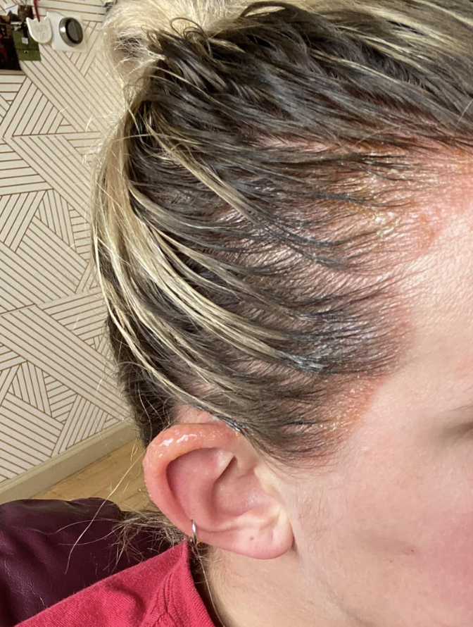 Close-up of a person's ear and side of their head showing what appears to be hair dye or styling product around the hairline and ear