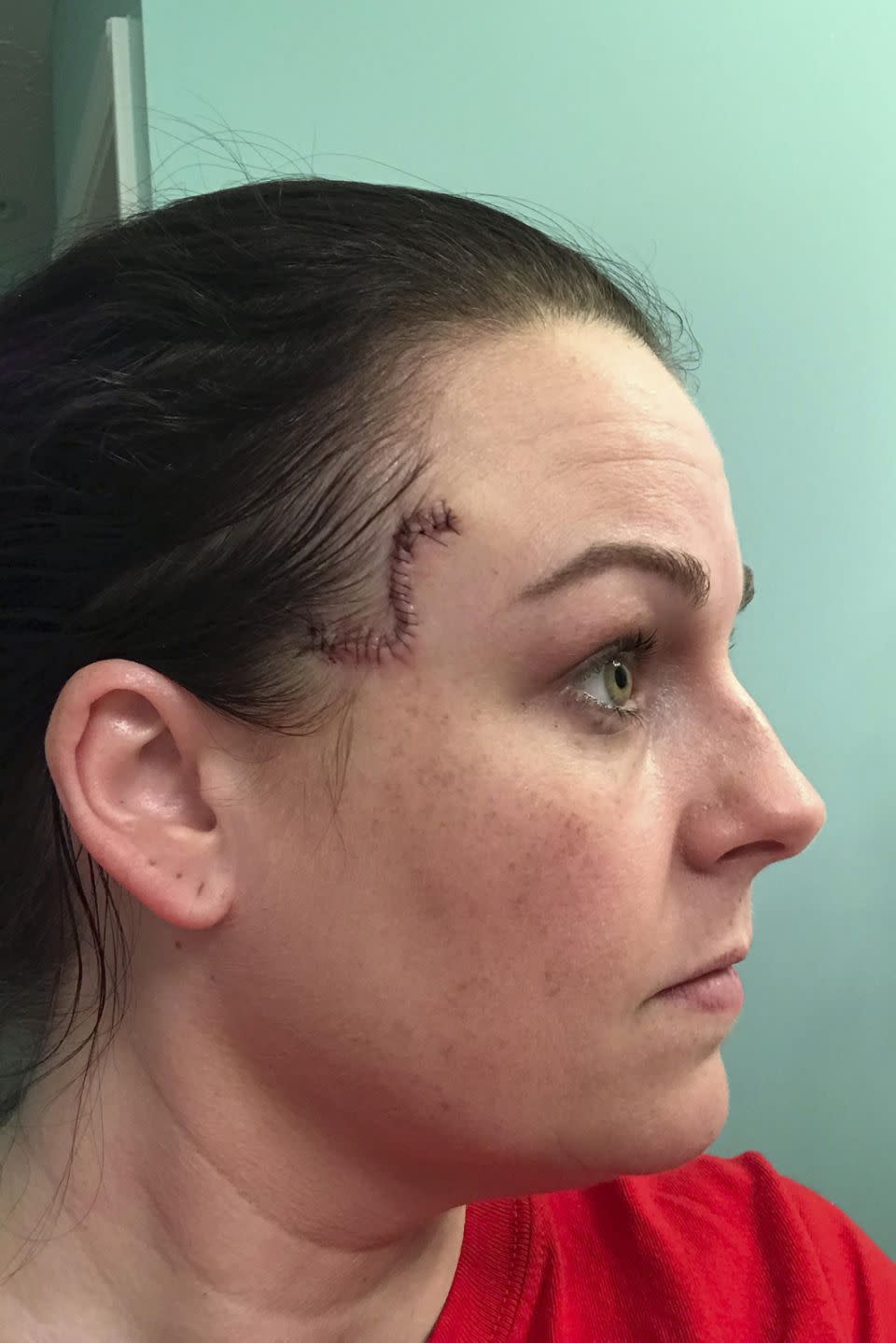 Jones was diagnosed with basal cell carcinoma — a skin cancer that can cause extreme disfigurement if left untreated — two months ago. (Photo: Caters)