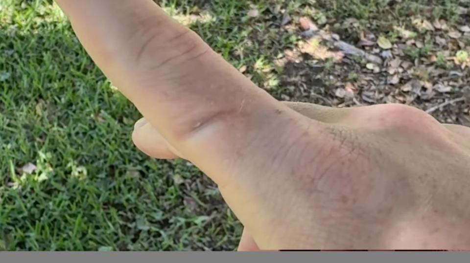 Judkins said the “frunk” door could have severely injured his finger, which is seen above after the test. YouTube / Jeremy Judkins