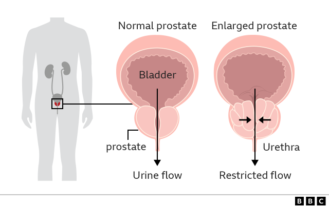 Pink Urine - What Causes Pink or Red Urine - Urology Austin