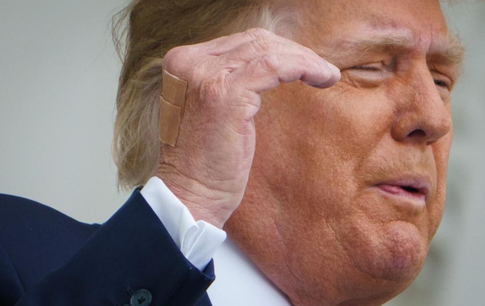 Bandages are seen on the back of his hand as US President Donald Trump speaks from the South Portico of the White House in Washington, DC during a rally on October 10, 2020.