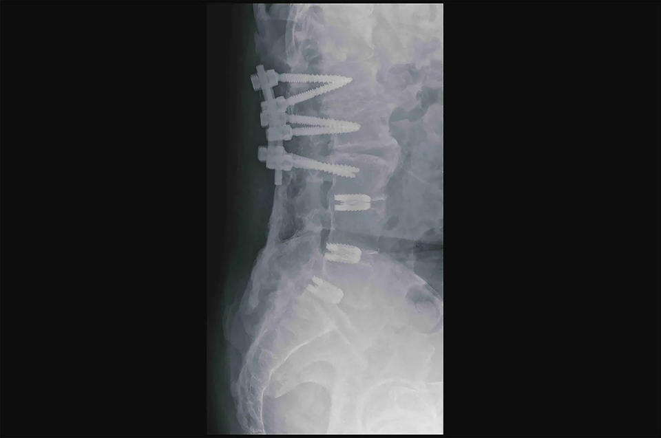 <strong>患者在他院手術後，腰椎人工植入物的情況。（示意圖／彰化基督教醫院）</strong>