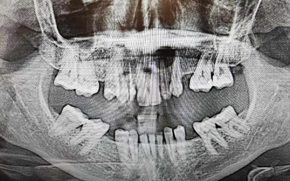 Scans taken ahead of Shalom Dawson's surgery, illustrating the abscess. "Having an infection in your mouth is quite serious," she says.  