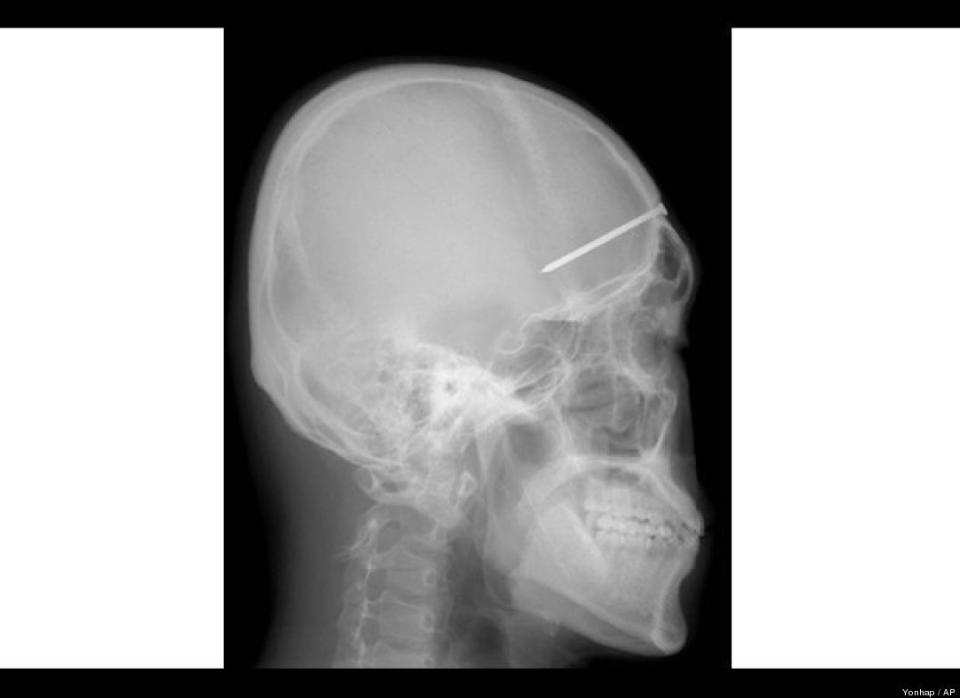 A nail rests in a South Korean man's skull in December 2004. He sought help for a bad headache and upon discovery said it likely happened four years earlier.