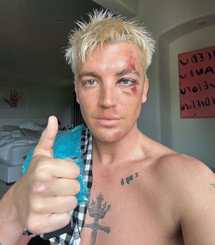 <p>Paul Klein/Instagram</p> Paul Klein with his thumbs up after being hit by a car