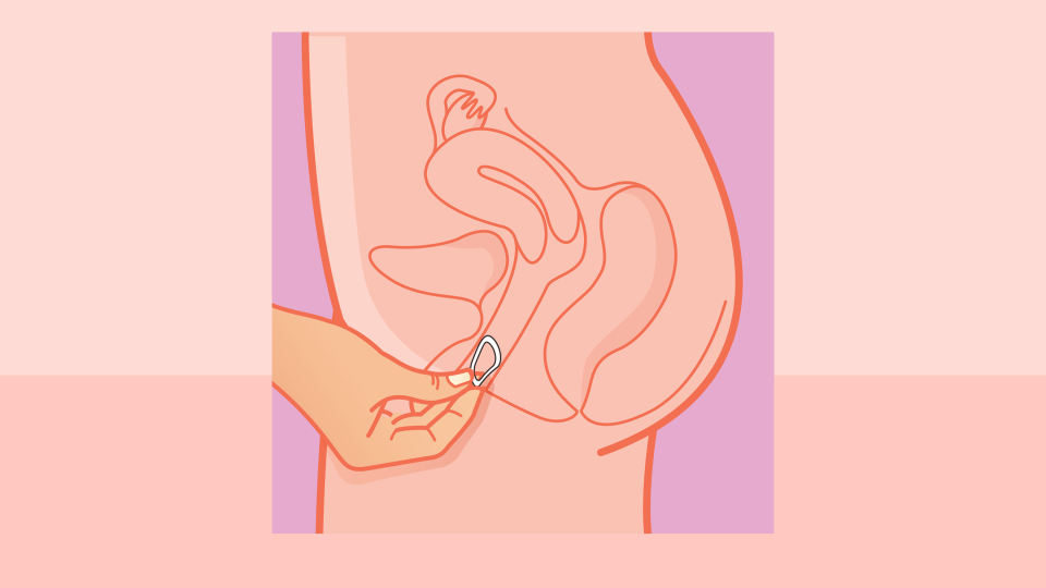 Unlike an IUD procedure, insertion of a vaginal ring can be done without a doctor's help.