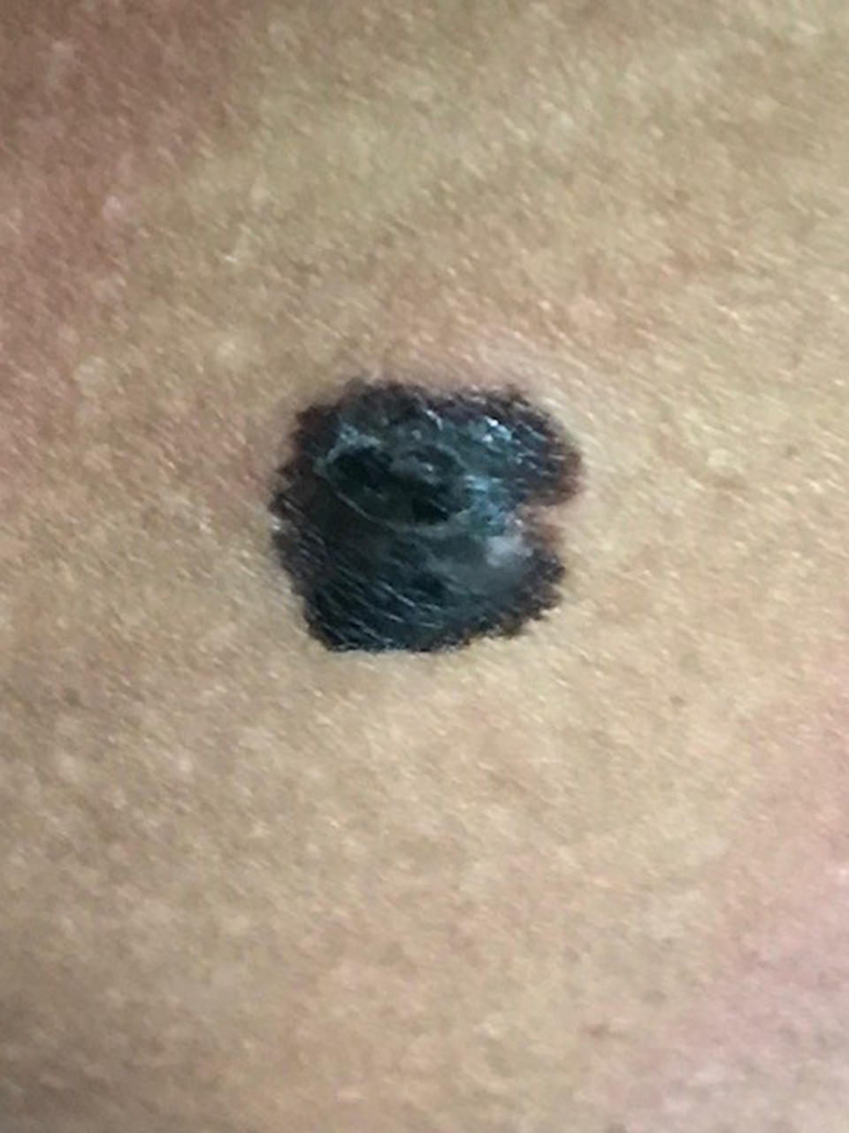 Ila Smith, Skin Cancer (Courtesy Ilia Smith)