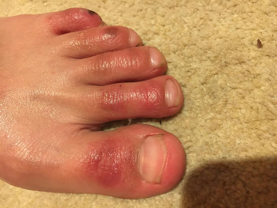 Covid toes (Photo: COVID Symptom Study)