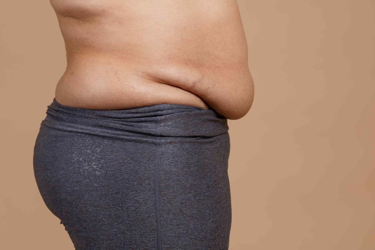 What Causes An Apron Belly And How To Get Rid Of It
