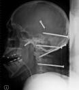 Six nails embedded in the skull of construction worker Isidro Mejia, 39, after an industrial incident caused a nail gun to shoot nails into his head and brain on April 19, 2004, are seen in this X-ray image from Providence Holy Cross Hospital in Los Angeles. Five of the six nails were removed in surgery that day and the sixth was removed from his face on April 23, after the swelling went down. (AP Photo/photo released by Providence Holy Cross Medical Center)