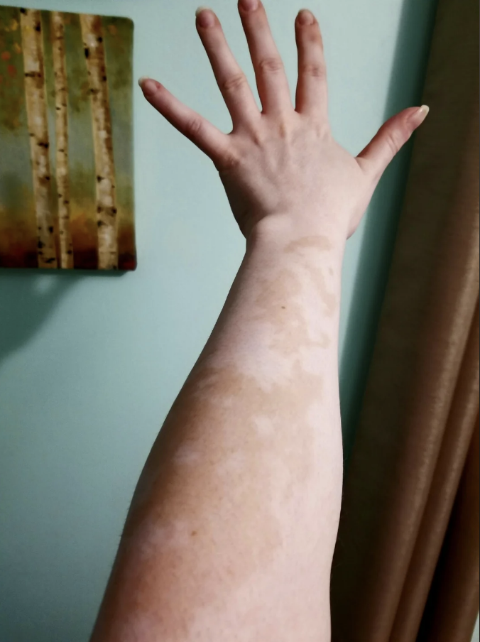 Person's arm extended upwards with visible vitiligo patches