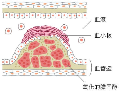 動脈硬化的血管