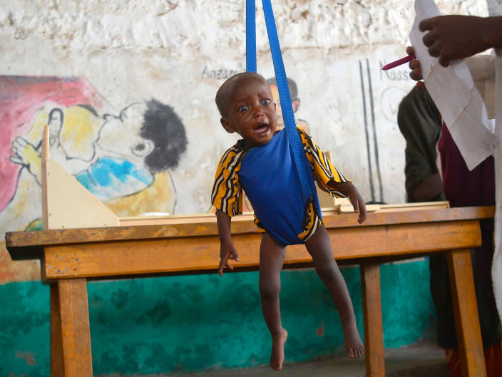 <p>MAR. 15, 2017 – A malnourished child is processed by an aid worker for a UNICEF- funded health programme catering to children displaced by drought, at a facility in Baidoa town, the capital of Bay region of south-western Somalia where the spread of cholera has claimed tens of lives of IDP’s compounding the impact of drought.<br> The United Nations is warning of an unprecedented global crisis with famine already gripping parts of South Sudan and looming over Nigeria, Yemen and Somalia, threatening the lives of 20 million people. For Somalis, the memory of the 2011 famine which left a quarter of a million people dead is still fresh. (Photo: Tony KarumbaAFP/Getty Images) </p>