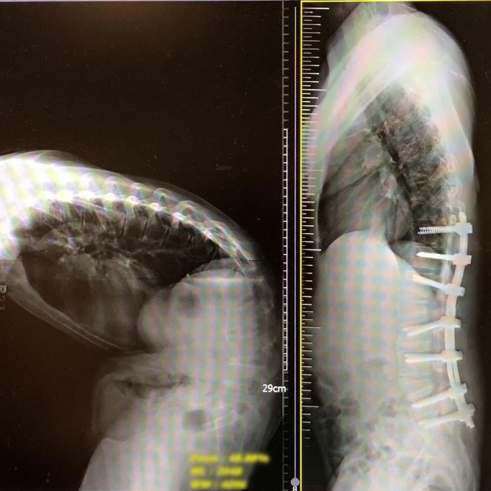 巴納瓦手術前只能維持固定的彎腰姿勢，術後終能挺直腰桿。