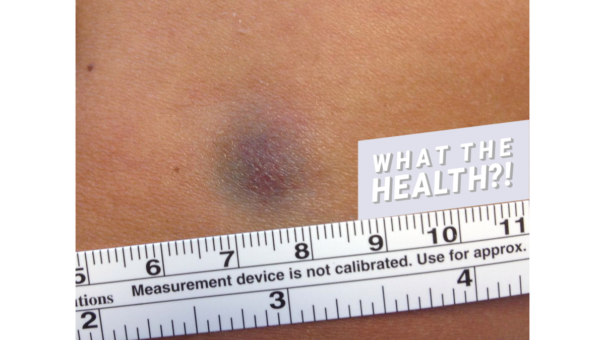 this-woman-s-tiny-bruise-turned-out-to-be-a-rare-form-of-skin-cancer