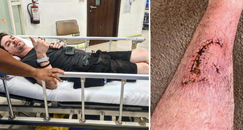 Mr Crocker gives the camera a 'thumbs up' in hospital (left) and snaps a picture of the stitches in his shin (right).