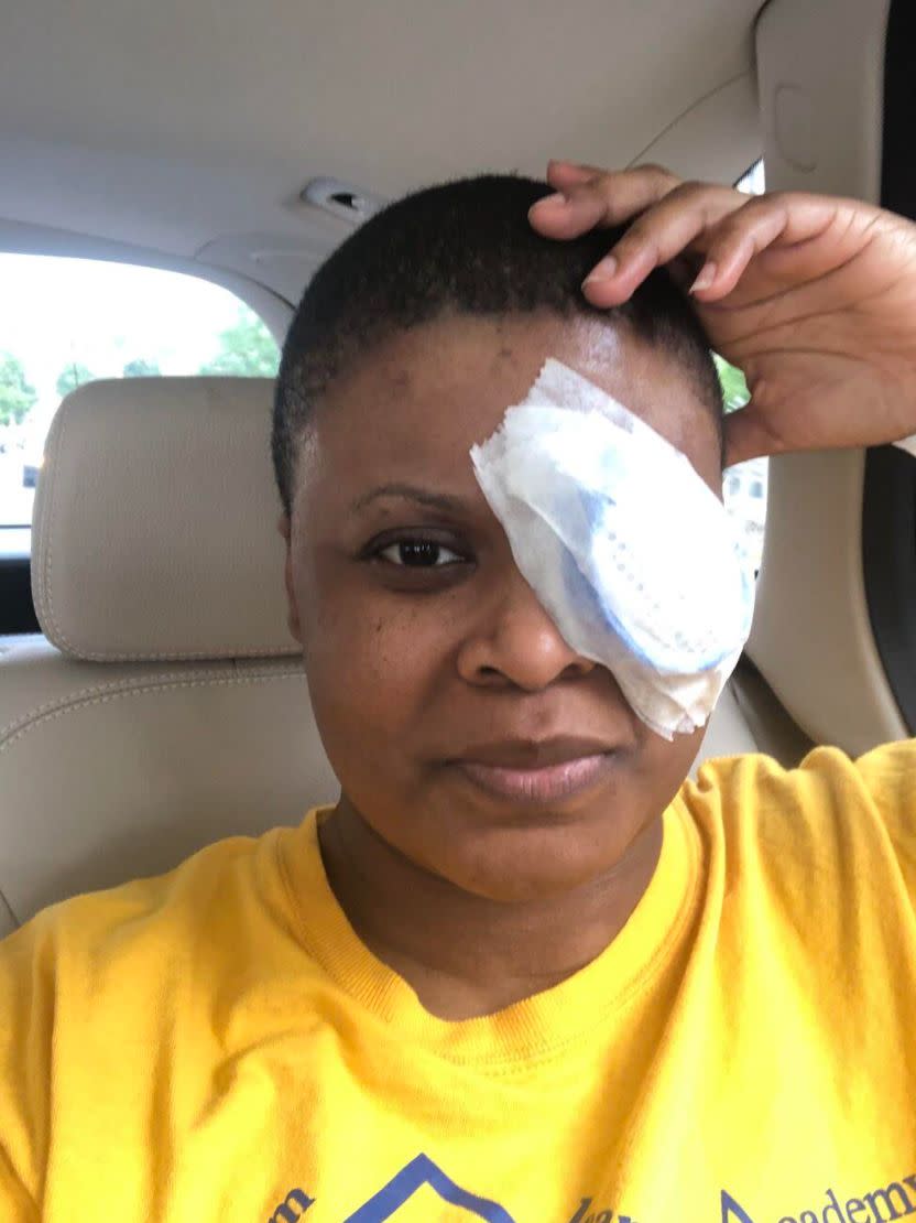 The author immediately following cataract surgery on Sept. 3, 2020. She developed a dense cataract following her COVID-19 infection. (Photo: Courtesy of Chimére L. Smith)