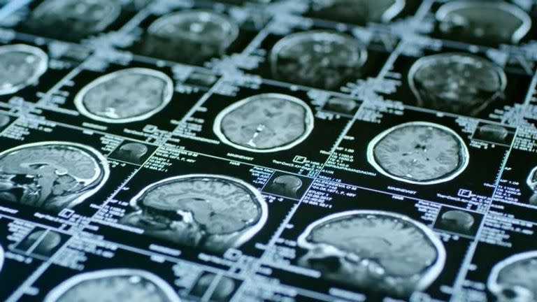La acumulación de líquido en cavidades cerebrales por causas que la ciencia aún desconoce puede generar demencia potencialmente reversible en los adultos mayores