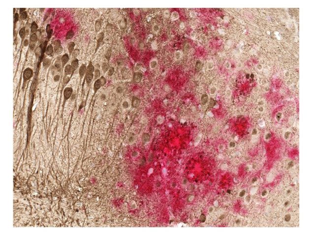 Toxic amyloid plaques (red) and tau tangles (brown) form in the brain of a mouse with Alzheimer’s disease (UT Southwestern/PA)