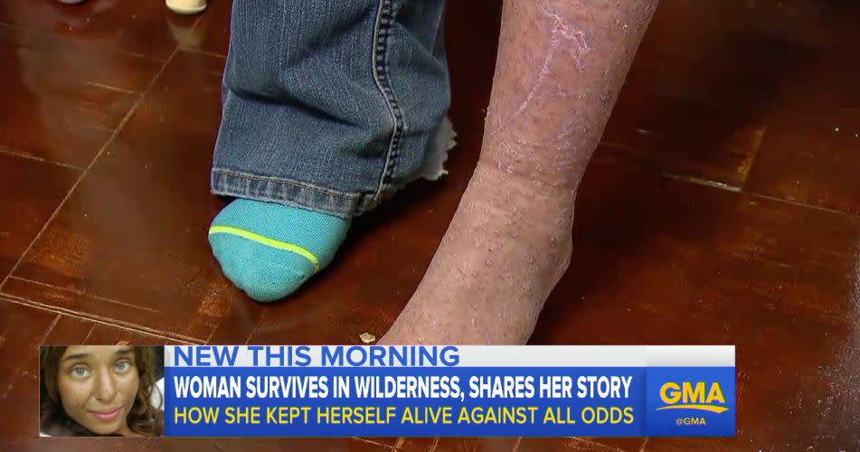 Theris shows off one of her scratched and bug-bite-covered legs after her rescue. (Photo: ABC News)