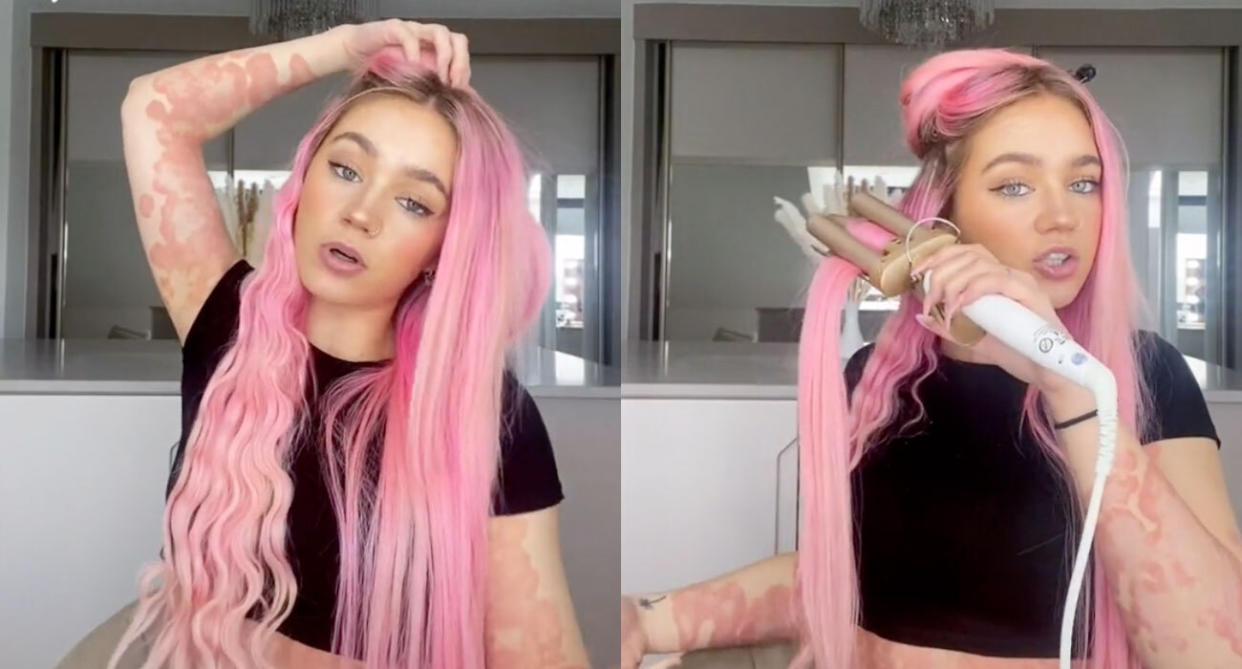 Rosie Daniels is documenting her psoriasis journey online. (Photo: Rosie Daniels/TikTok)