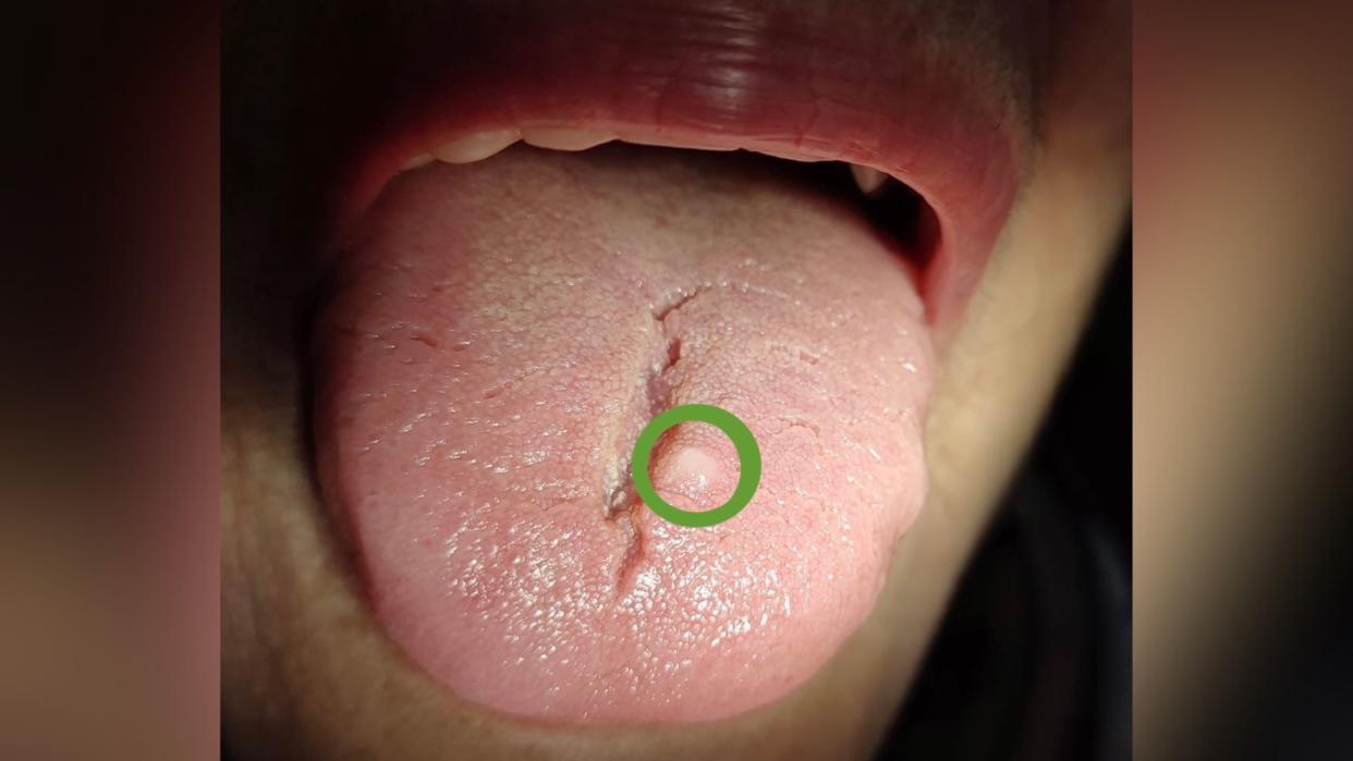  photo shows a close up of a woman's tongue, with a small white bubble on its surface circled in green 