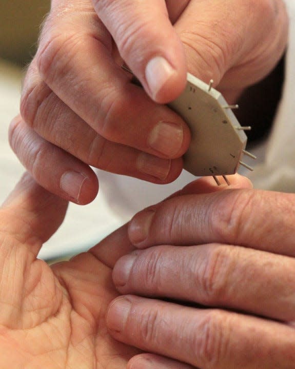 Dr. T. J. Reilly, M.D. examines the right hand of Anna Marie Wilton, 83 of Akron where he performed surgery for carpal tunnel five years ago. Wilton was there to have her left wrist examined and to schedule surgery.