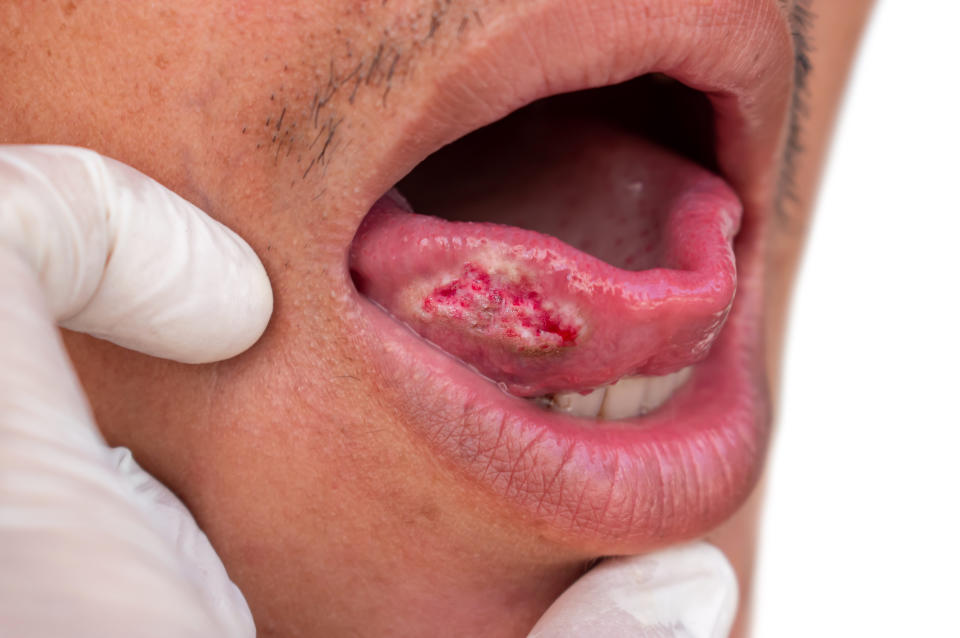 Squamous cell carcinoma of tongue. Oral cancer or malignant tumor of Asian male patient.