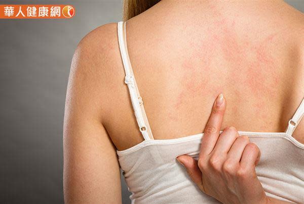 異位性皮膚炎不只是過敏或乾燥　和心理壓力也有密切關係