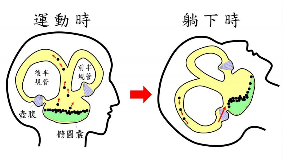 患者運動時，耳石掙脫耳石器，離開橢圓囊。<br />圖右：耳石進入後半規管，沉積其內，就會改變姿勢時，帶動內淋巴液在半規管內的迴流。