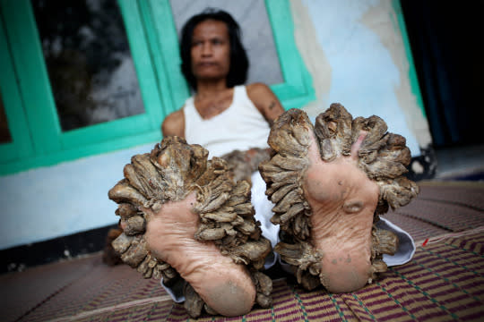 Indonesian ‘tree man’ dies at age 42 after years of battling rare disease